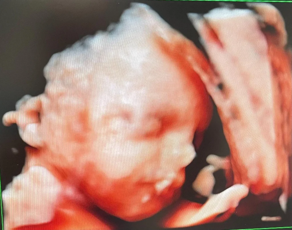 4D-ultralydsbillede af foster med realistisk farvegengivelse.